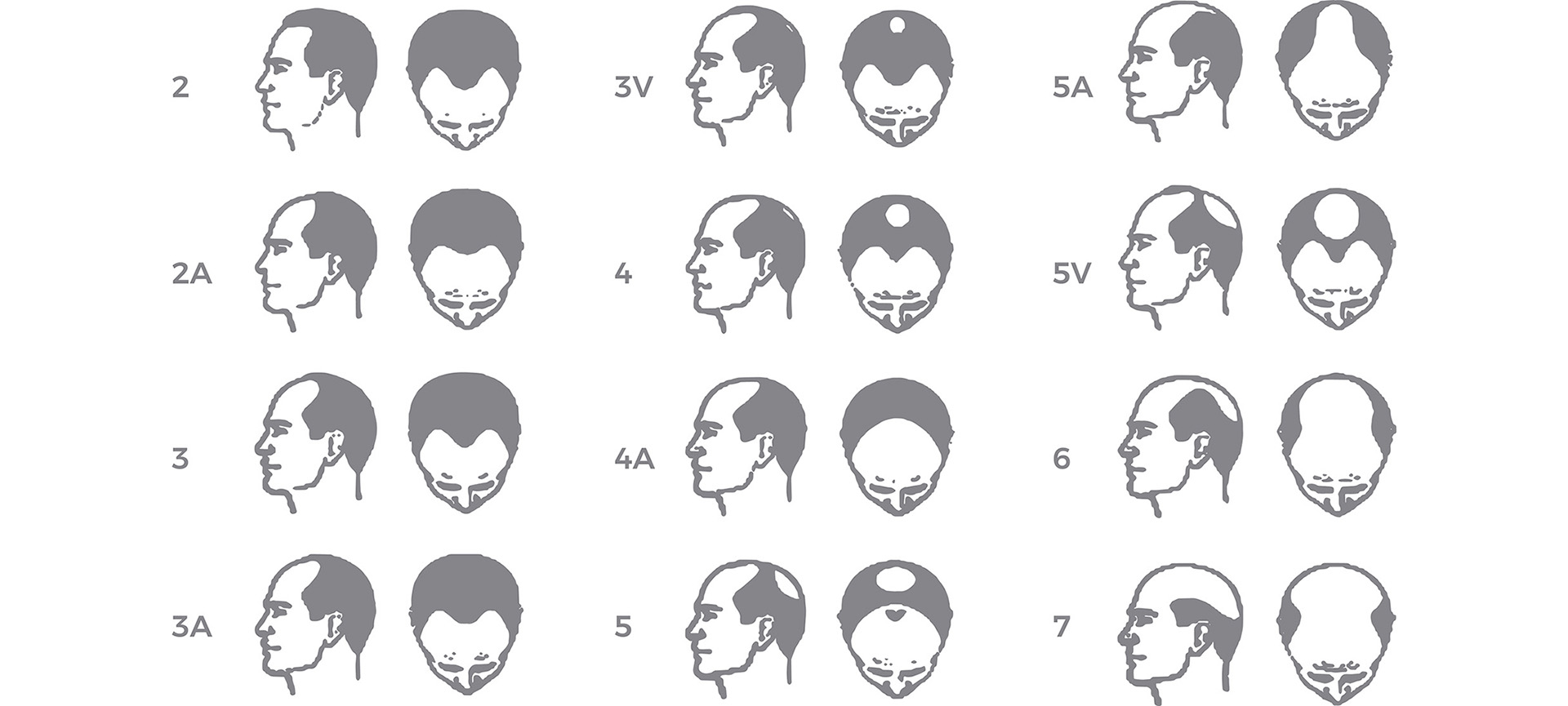 alopecia escala hamilton norwood